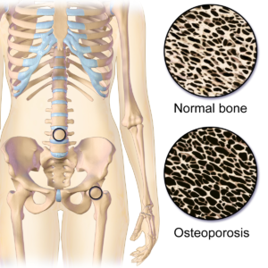 Locations of Osteoporosis