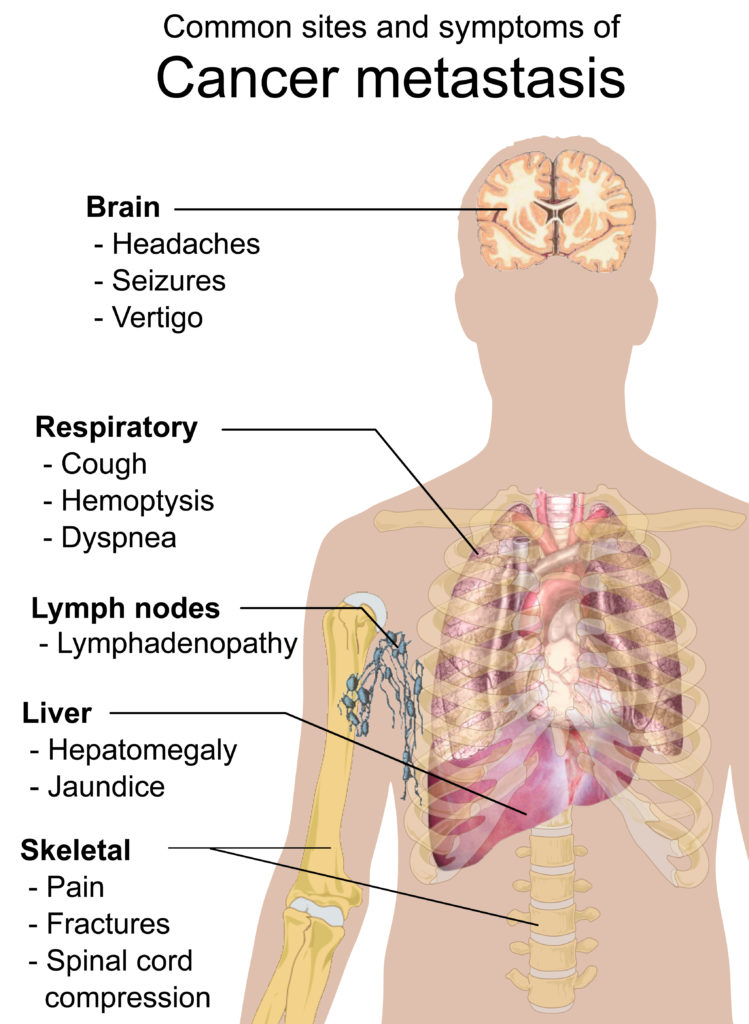 Symptoms of brain Cancer