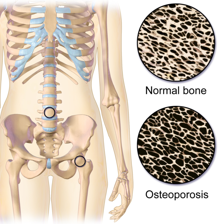 Osteoporosis medicine reduces risk of premature mortality post 50