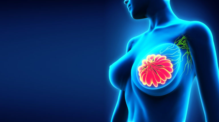 Immune cells could play a role in breast cancer metastasis