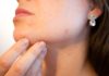 Acne, pimples, skin disease, face