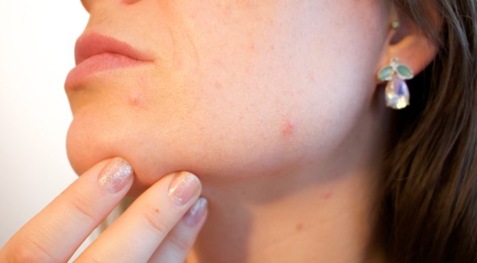 Acne, pimples, skin disease, face