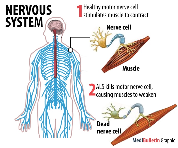 An Infographic explaining ALS