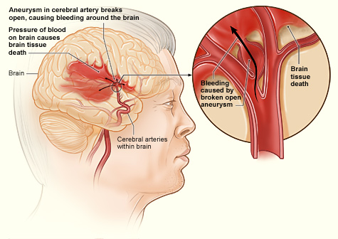 Stroke patients receive better care in teaching hospitals