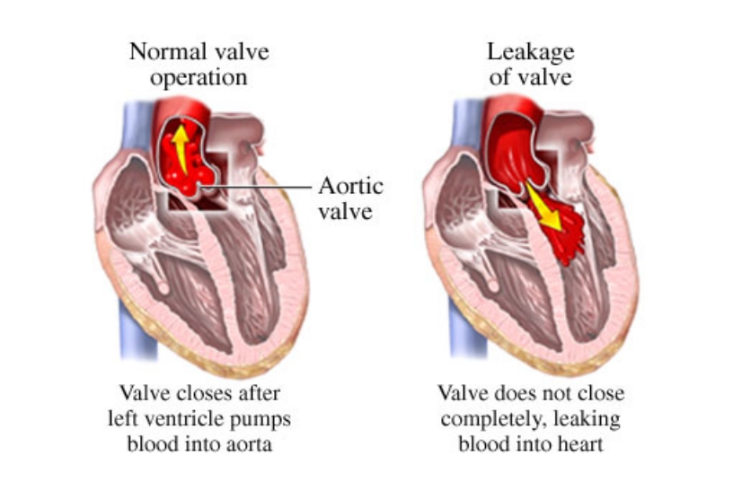 Leaky Heart Valve
