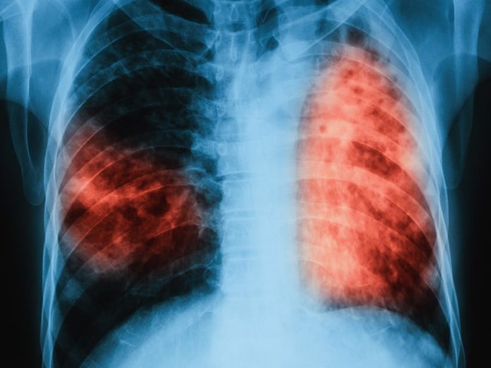 Chest Xray of a TB patient