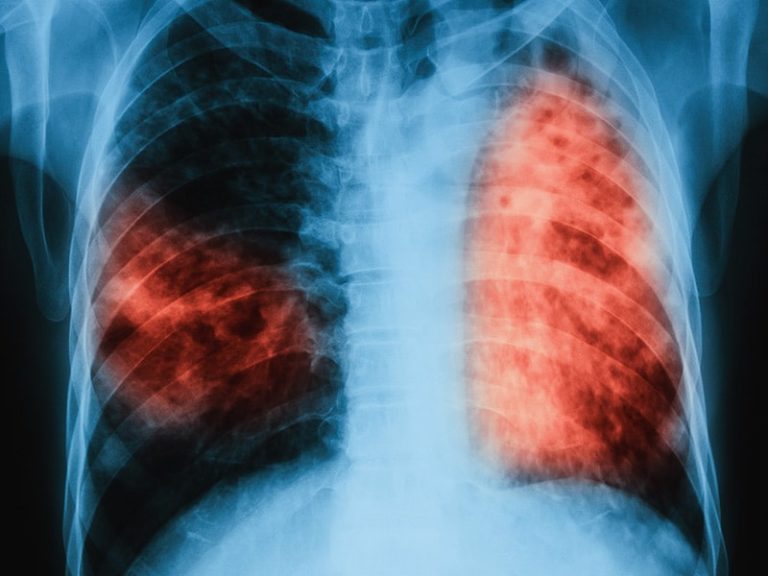 Artificial intelligence new weapon in India’s tuberculosis armoury