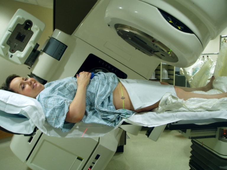 Statins protect cancer patients on radiotherapy, from stroke
