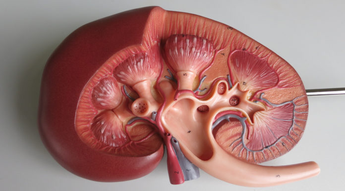 Human kidney transplant, nephrosis