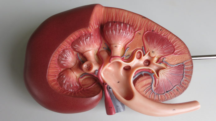 Human kidney transplant, nephrosis