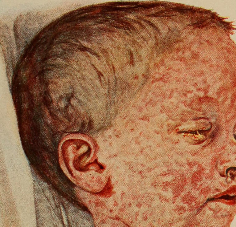 Measles making a comeback the world over, WHO warns