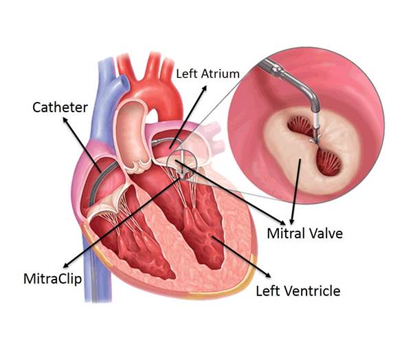 Mitral valve