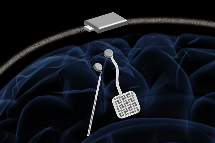 Brain pacemaker from UC Berkeley can treat Parkinson’s, epilepsy