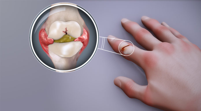 Rheumatoid arthritis, Swollen finger, joint pain
