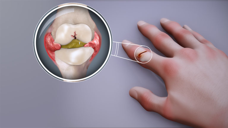 Rheumatoid arthritis, Swollen finger, joint pain
