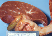 Liver transplant, organ donation